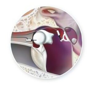 Close up diagram of inner ear showing implantable cochlea device.