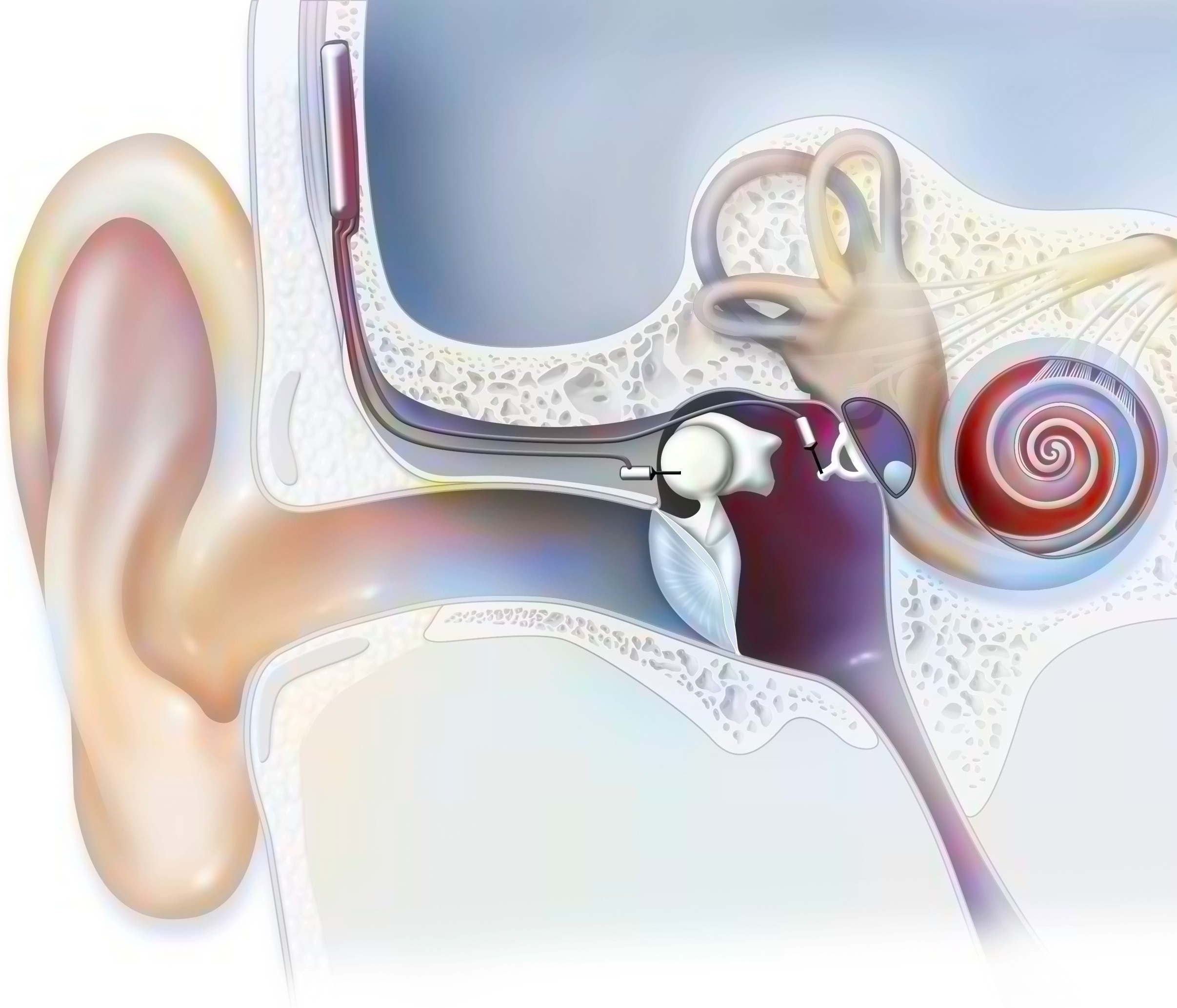 Diagram of inner ear showing implantable cochlea device.